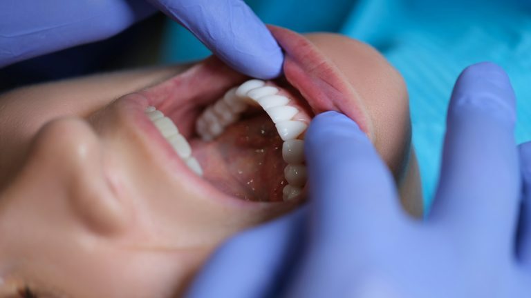 Modern Veneers